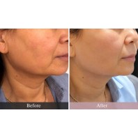 DermaShine® Glass Skin Treatment 