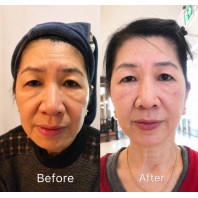 HIFU Skin Lifting Treatment
