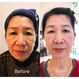 HIFU Skin Lifting Treatment